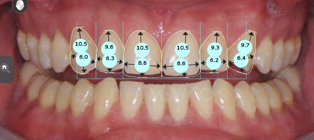 Carillas De Porcelana Sin Tallado Barcelona Smile Center