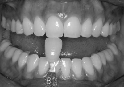 Tratamiento de Blanquamiento dental en Barcelona