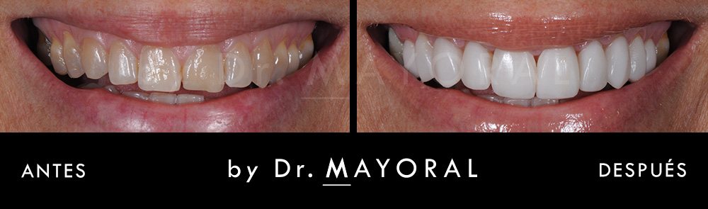 Carillas dentales antes y después: pacientes de Clínicas Den