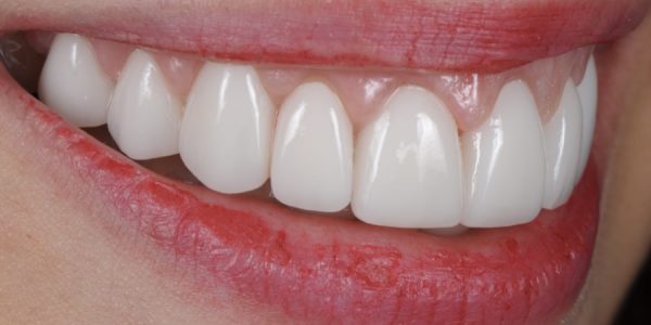 Modulo Carillas Dentales-920px